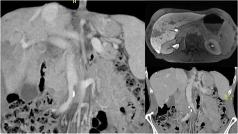 Initial diagnostic imaging showing liver lesions on computed tomography ...