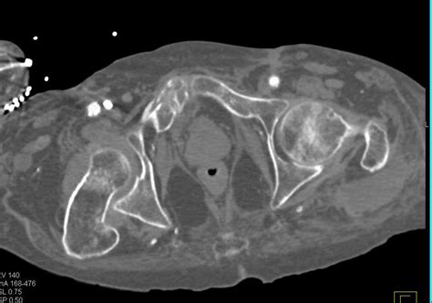 Symphysis Fracture - Musculoskeletal Case Studies - CTisus CT Scanning