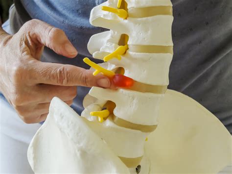 Endoscopic Spine Surgery: An Alternative to Lumbar Spinal Fusion? - Washingtonian