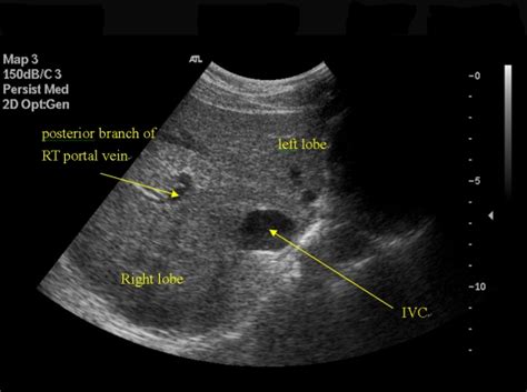 Transverse View of LIVER (3) | Ultrasound, Sonography, Radiology