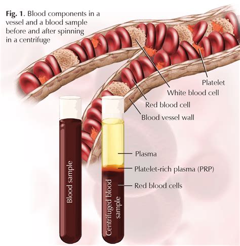 Platelet-Rich Plasma Therapy - Wellness at Hughston Clinic - Tennessee