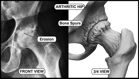 ~ Arthritic Hips & Knees Images – Hip and Knee Handbook of Joint ...