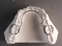 lower lingual holding arch | Orthodontic appliances, Orthodontics, Teeth