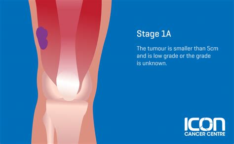 What is Soft Tissue Sarcoma? Soft Tissue Sarcoma Explained — Icon Cancer Centre