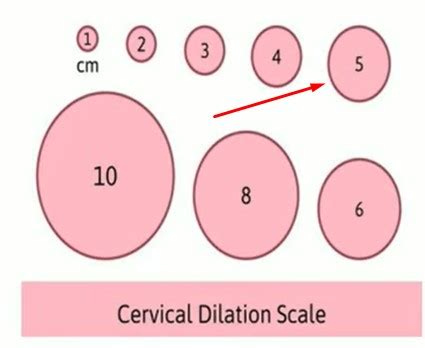 5Cm Dilated No Contractions