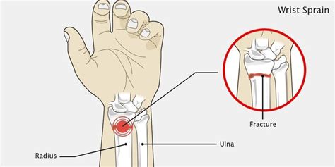 Sprained Wrist Injury | Sprained wrist, Wrist injury, Sprain