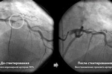 Coronary stenting: rehabilitation after surgery