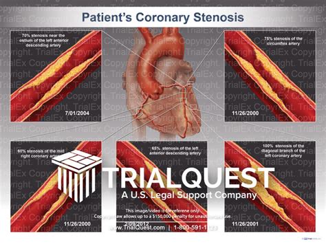 Coronary Stenosis - TrialExhibits Inc.