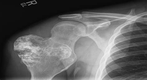 Common Tumors and Tumor-like Lesions of the Shoulder : JAAOS - Journal ...