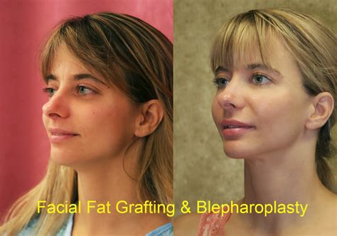 Beverly Hills Plastic Surgeon: Facial Fat Grafting in Los Angeles can make you look younger