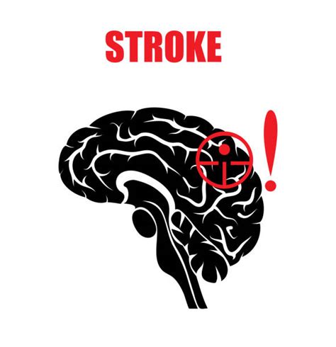 60+ Ischemic Stroke Icon Illustrations, Royalty-Free Vector Graphics & Clip Art - iStock