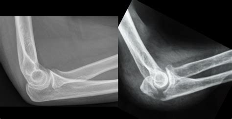 Olecranon Fossa X Ray