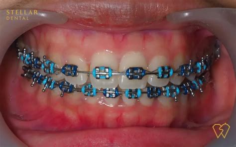 Braces Colors: Top Picks For 2023 - Stellar Dental