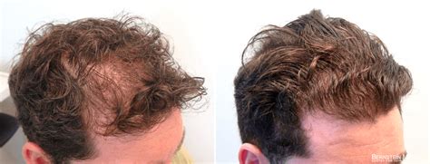 eszközök Tabletta lefoglal minoxidil 5 before and after Fuss feneketlen ...