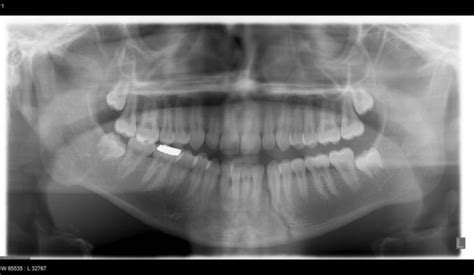 Fracture of Mandible - radRounds Radiology Network