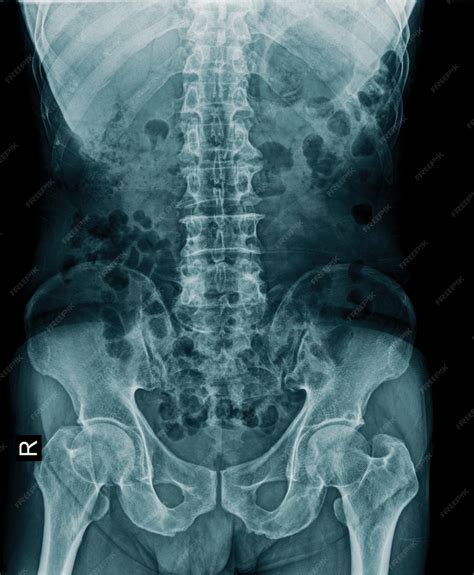 Sacrum Anatomy Xray