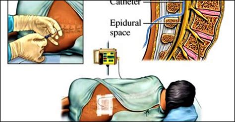 Epidural For Labor What Is An Epidural Epidural Side - vrogue.co