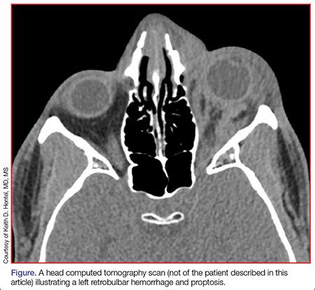 Spontaneous Retrobulbar Hemorrhage | MDedge Emergency Medicine