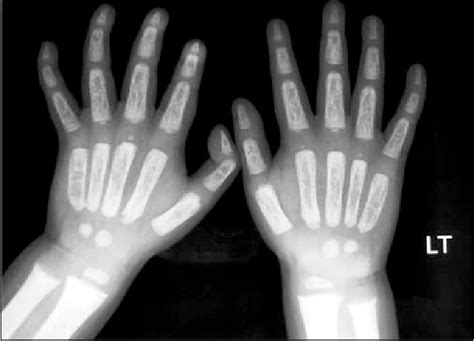 Figure 2 from Child with Mongolian spots and dysostosis multiplex ...