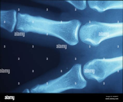 X-ray picture of finger bones with joints Stock Photo - Alamy