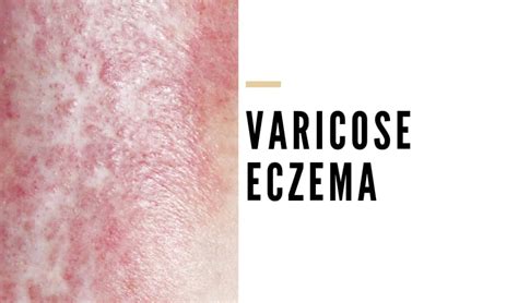 What is Varicose Eczema? - Vein Solutions