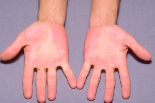 Erythromelalgia - NHS