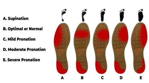 supination-severity-diagram - Riktr PRO Deep Tissue - Sports Injuries ...