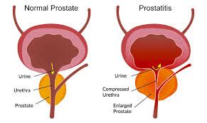 Causes, Symptoms, and Treatment of Prostatitis - Top Urologist NYC