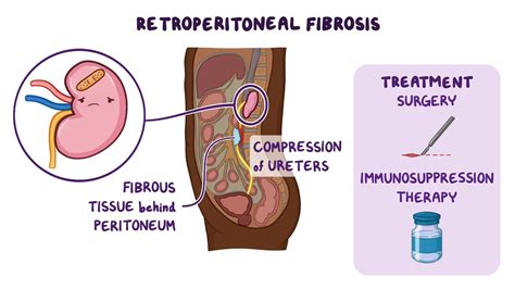 Retroperitoneal Diagram