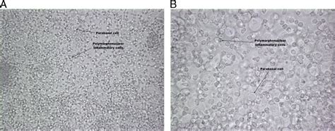 Desquamative Inflammatory Vaginitis as an Expression of Syst ...