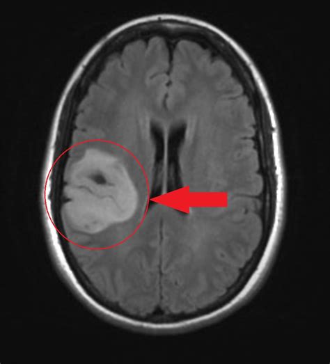 Astrocytoma MRI - wikidoc