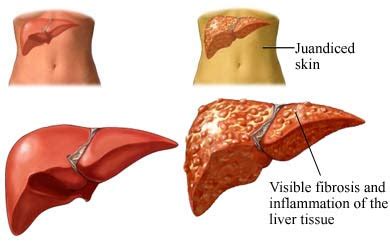 liver transplant procedure