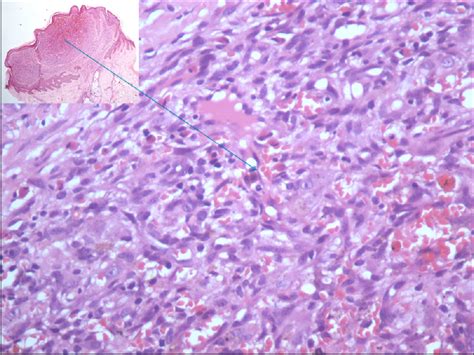 Recurrent unilateral angiolymphoid hyperplasia with eosinophilia in ...