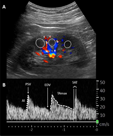 A Long axis view of Doppler renal ultrasound and B spectral wave form ...