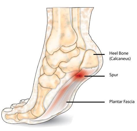 Posterior Heel Spur | Dr Bijan 4 Feet