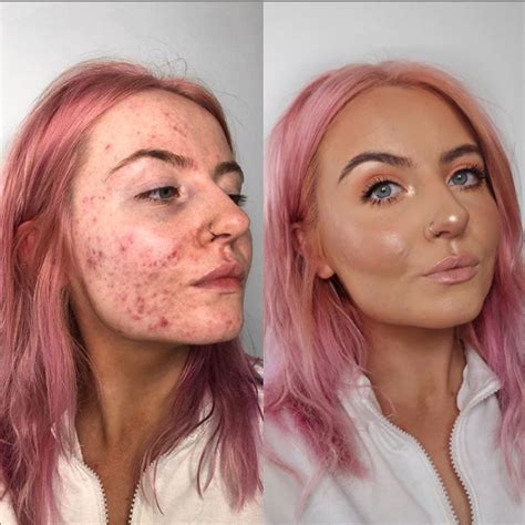 This foundation is going viral after cystic acne sufferer shares her 'insane' before-and-after ...