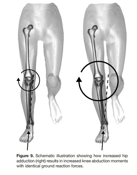 Greg Lehman on Twitter: "@markk42k was associated with knee pain. So anything that contributed ...