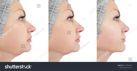 2,997 Chin Surgery Procedure Images, Stock Photos & Vectors | Shutterstock