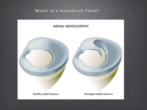 Posterior Horn Medial Meniscus Tears - Howard Luks, MD