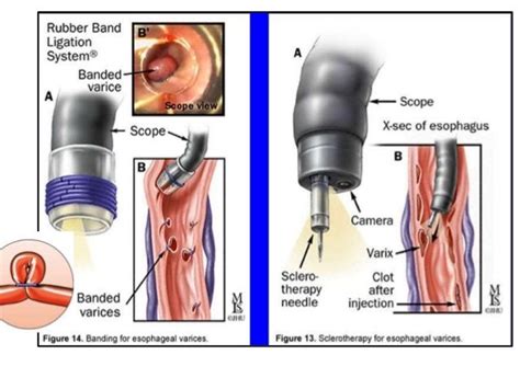 Esophageal varices