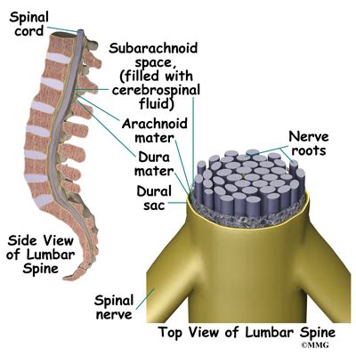 Pain Pumps - eOrthopod.com