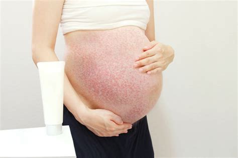 How to recognize and treat PUPPP rash - Evolving World