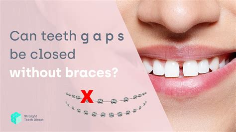 Why is it essential for teeth gap filling? - Aquafresh Prime