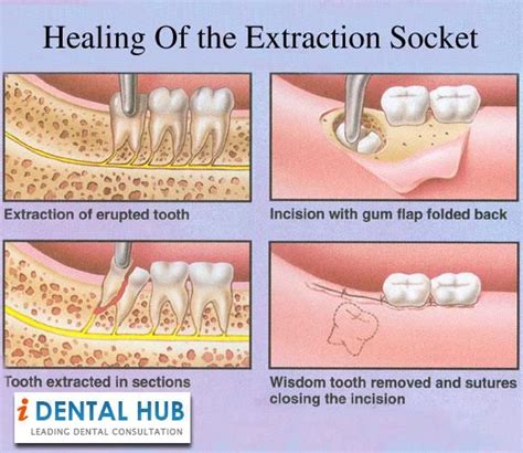 The healing process of the extraction socket starts immediately after ...