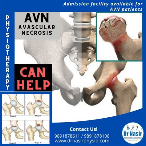 Avascular Necrosis (AVN) - Dr NasirPhysiotherapy and Rehabilation