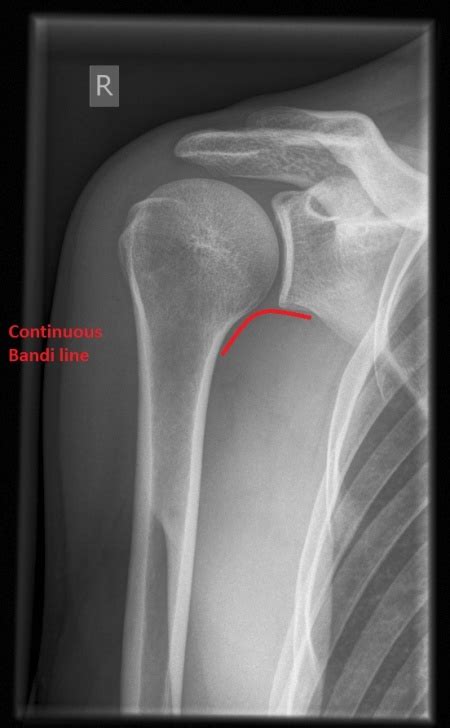 Shoulder x-ray interpretation - WikEM