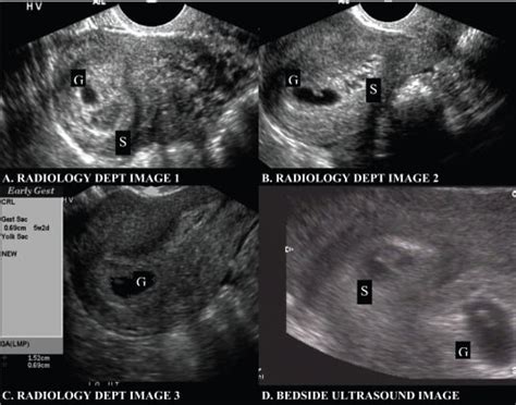 Subchorionic Hemorrhage Appearing as Twin Gestation on Endovaginal Ultrasound - The Western ...