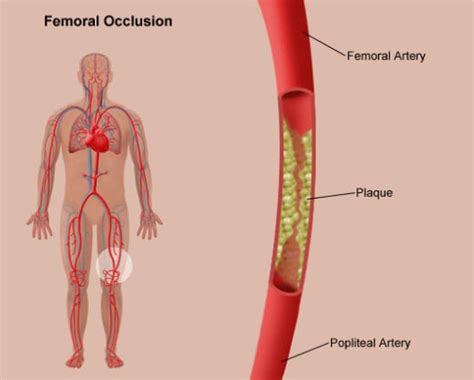 Understand Surgery: Femoral Popliteal Bypass