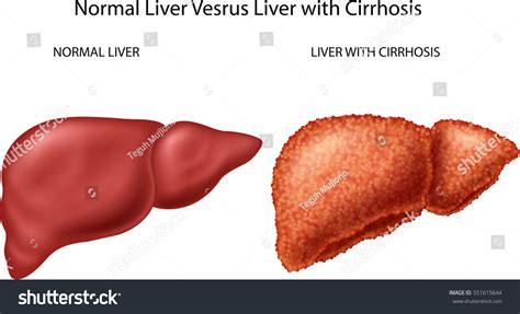 hígado normal versus hígado con cirrosis: vector de stock (libre de ...