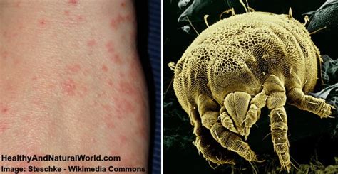 Mite Bites: Warning Signs and Natural Treatments